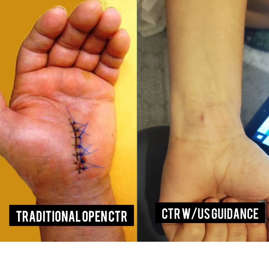 How Much Is Carpal Tunnel Surgery With Insurance: Cost Guide